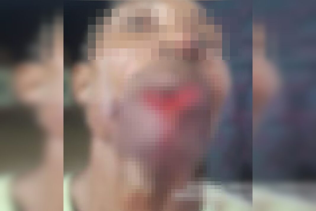 adolescente-arranca-parte-de-labio-de-homem-durante-briga-apos-bebedeira